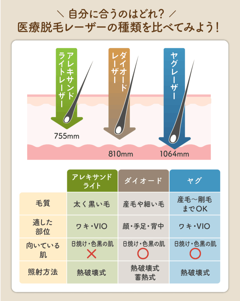 医療脱毛のレーザー照射をする種類