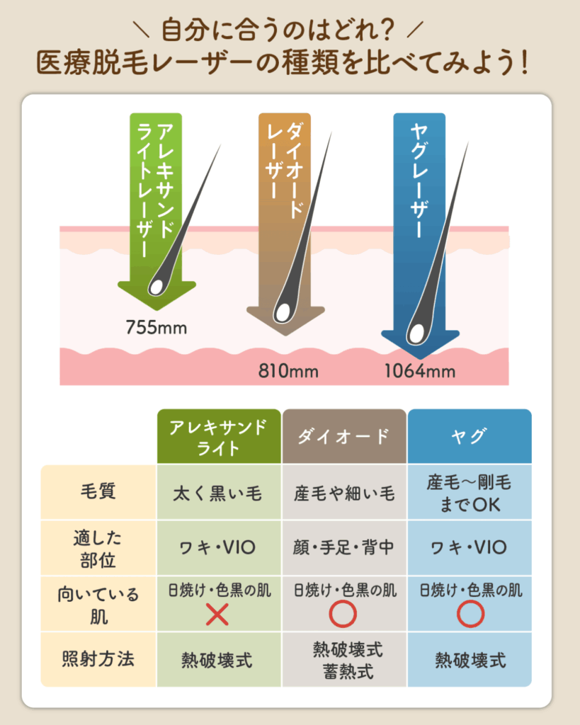 医療脱毛のレーザー照射をする種類